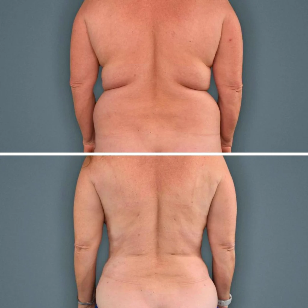 goldcoast liposuction lovehandles female 2023 rear 178 before and after before and after