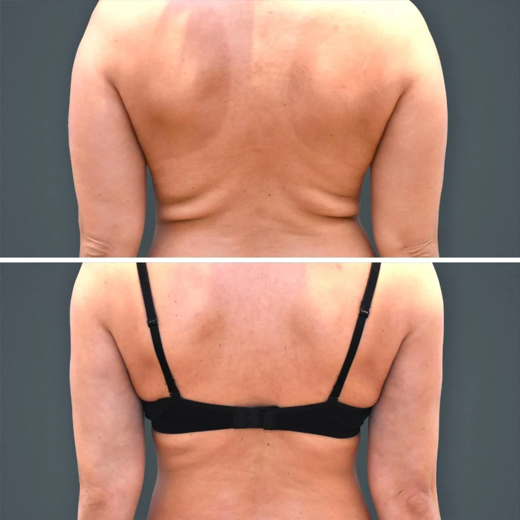 goldcoast liposuction lovehandles female 2023 rear 189 before and after before and after