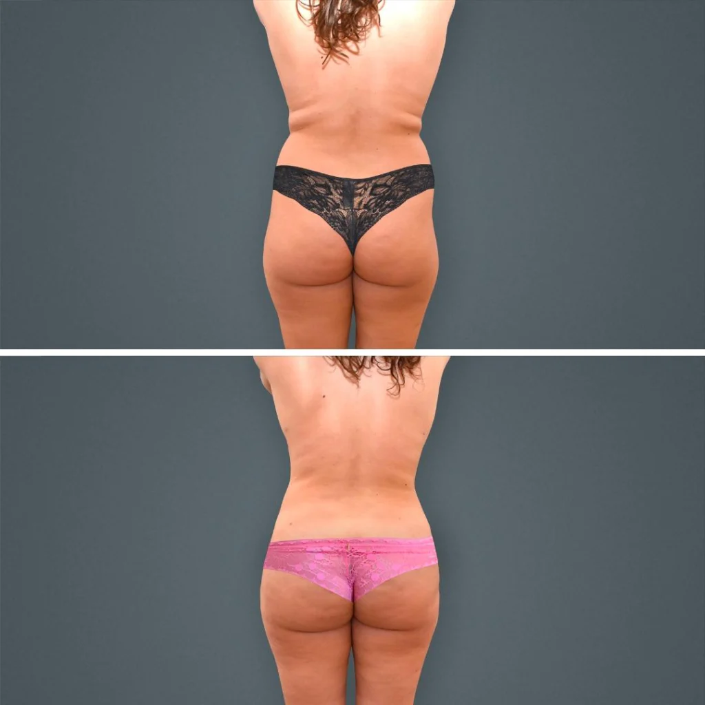 goldcoast liposuction lovehandles female 2023 rear 197 before and after before and after