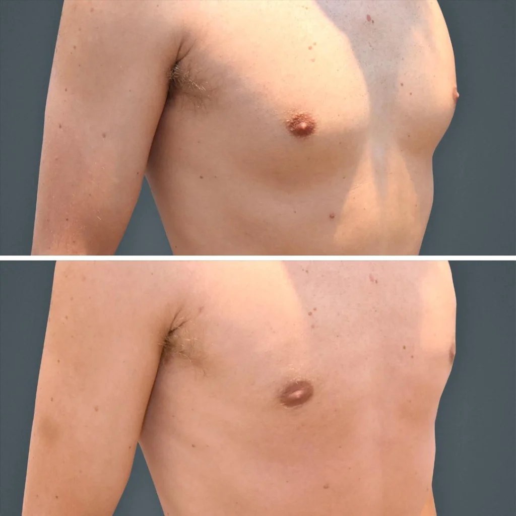 goldcoast liposuction manboobs male 2023 left 167 before and after before and after