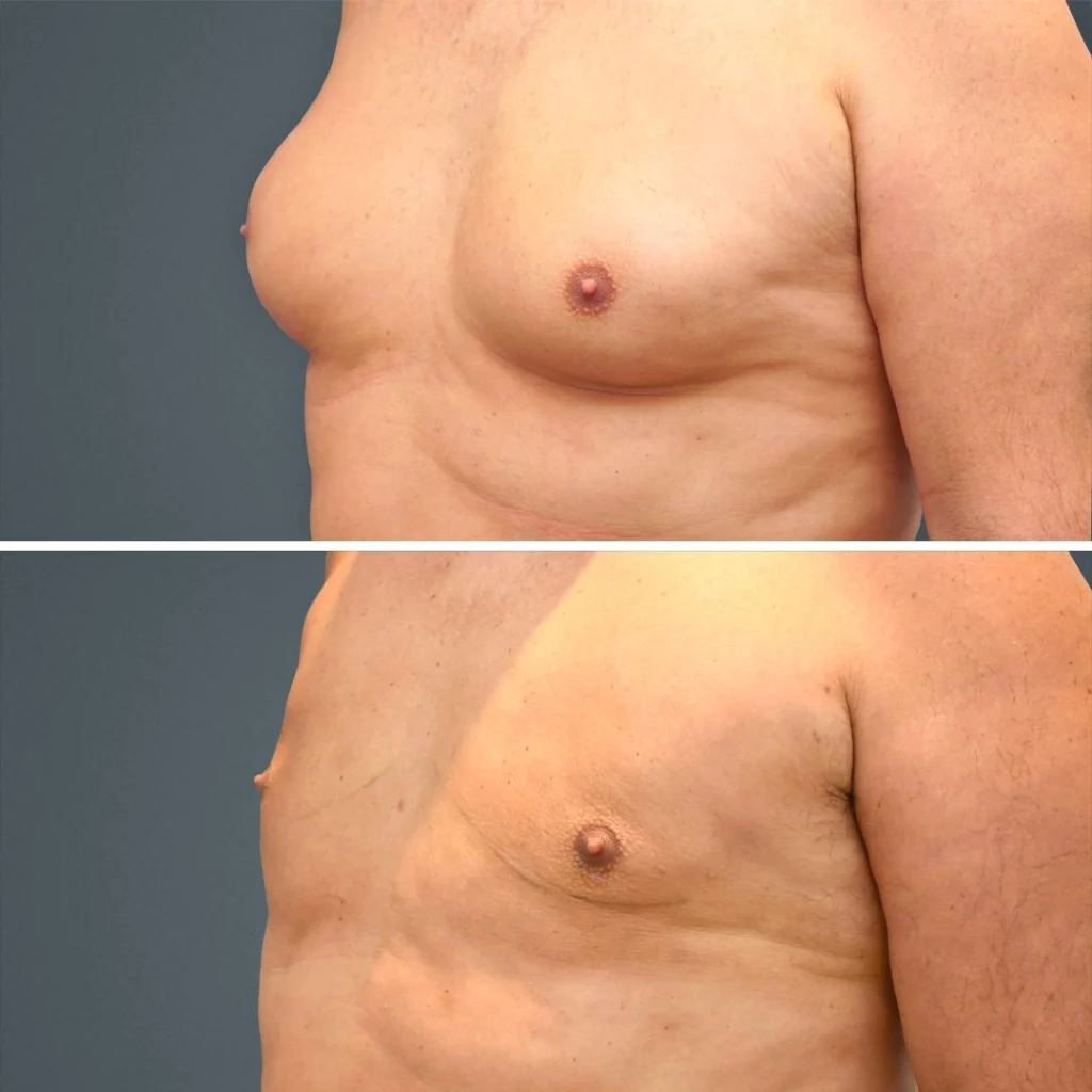 goldcoast liposuction manboobs male 2023 right 148 before and after before and after