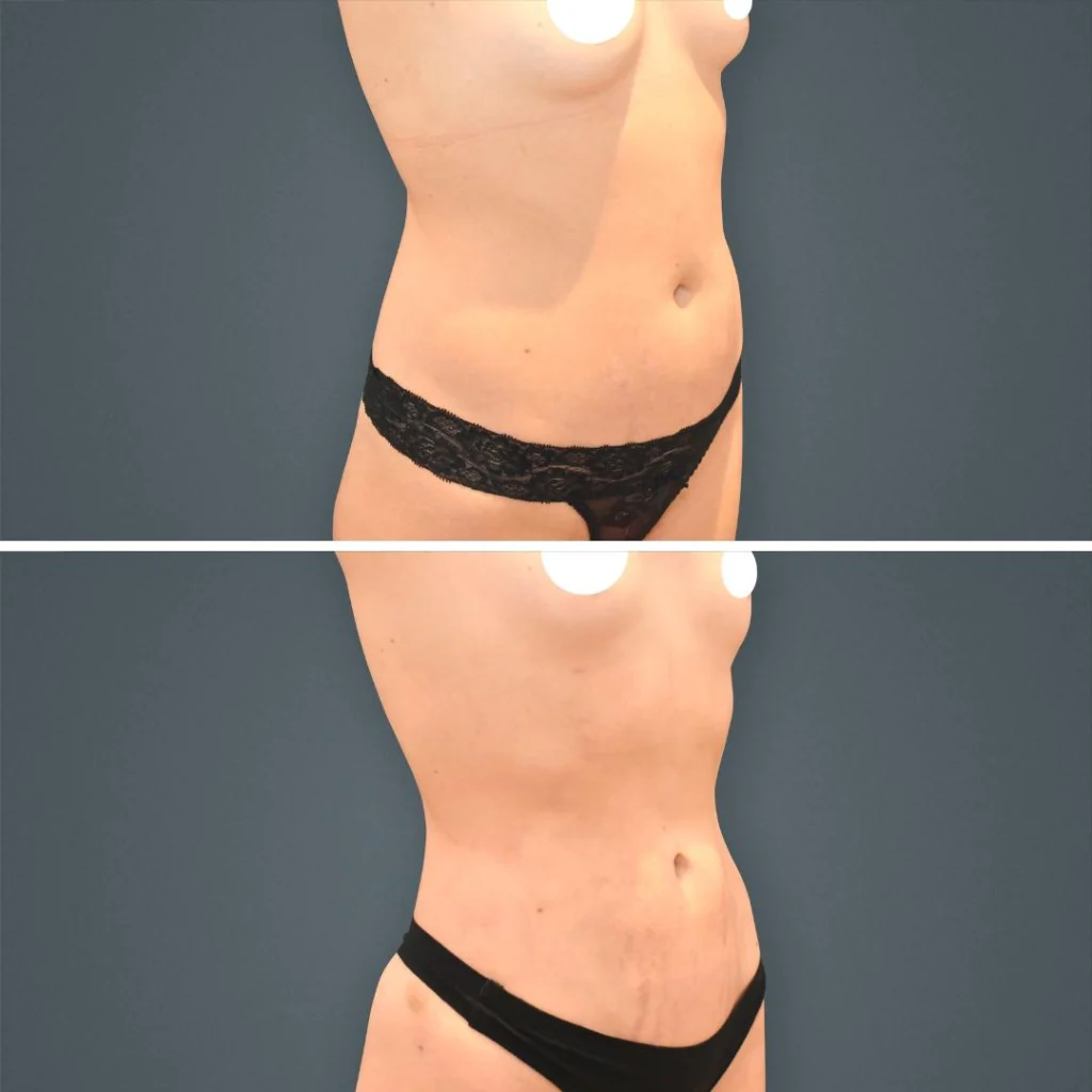 goldcoast liposuction stomach female 2023 left 196 before and after before and after