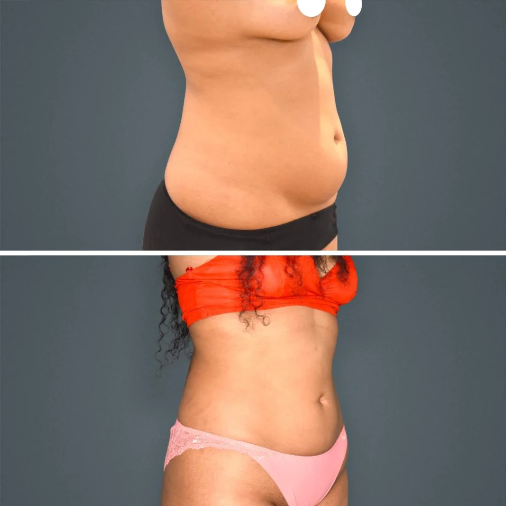goldcoast liposuction stomach female 2023 left 204 before and after before and after