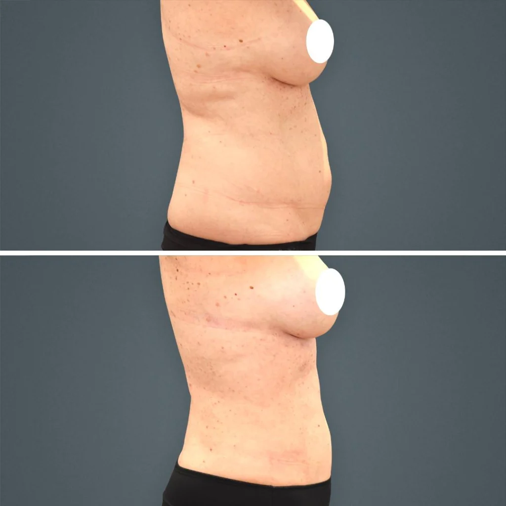 goldcoast liposuction stomach female 2023 left 207 before and after before and after