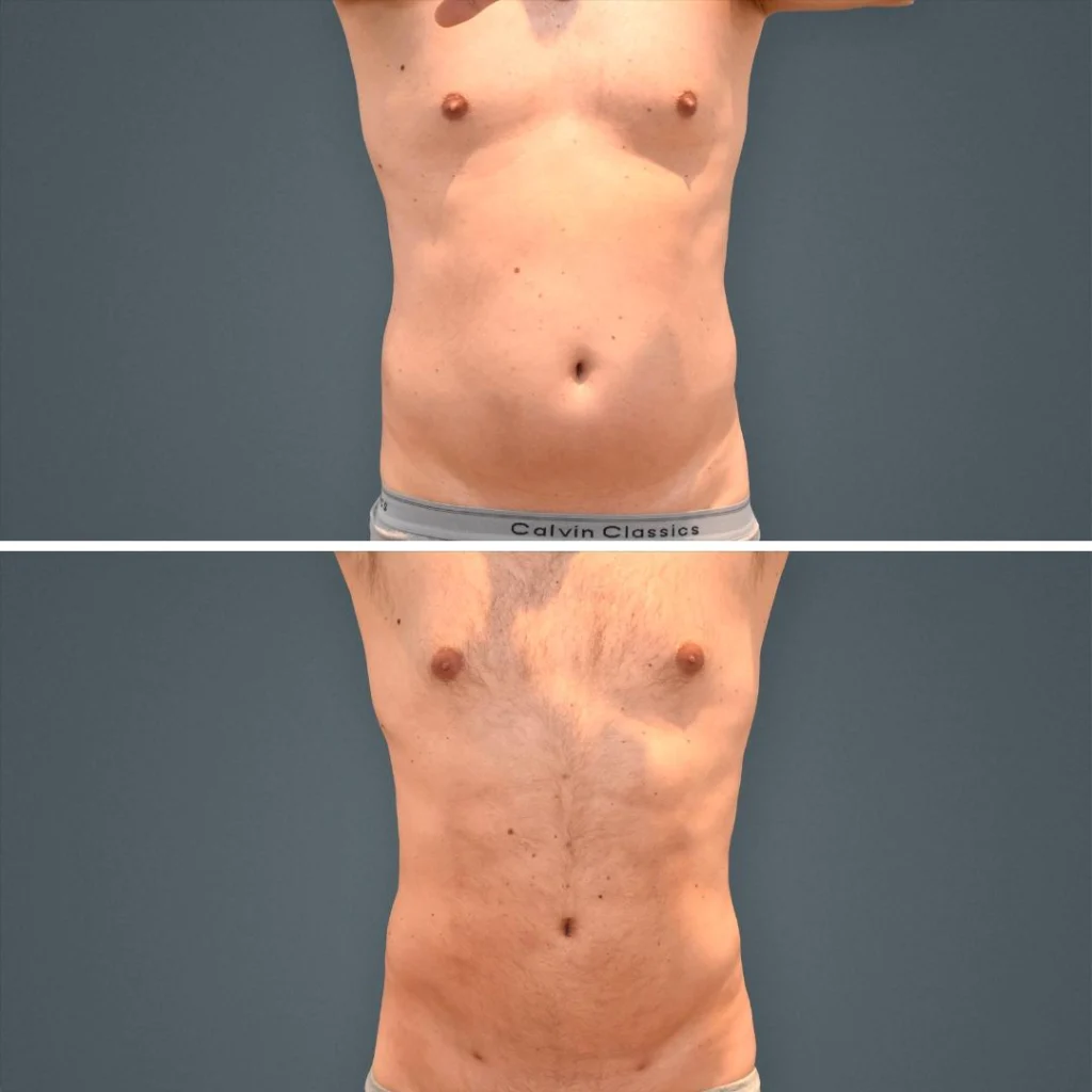goldcoast liposuction stomach male 2023 front 205 before and after before and after