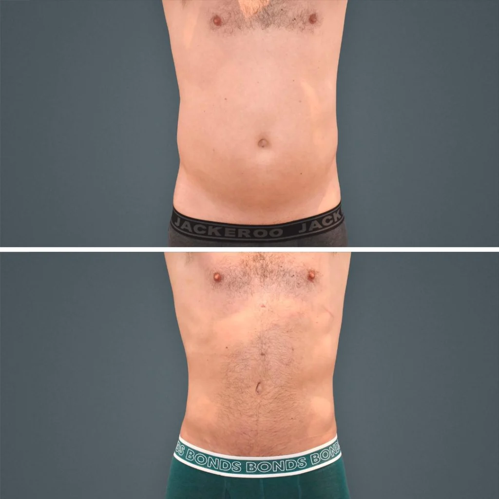 goldcoast liposuction stomach male 2023 front 206 before and after before and after