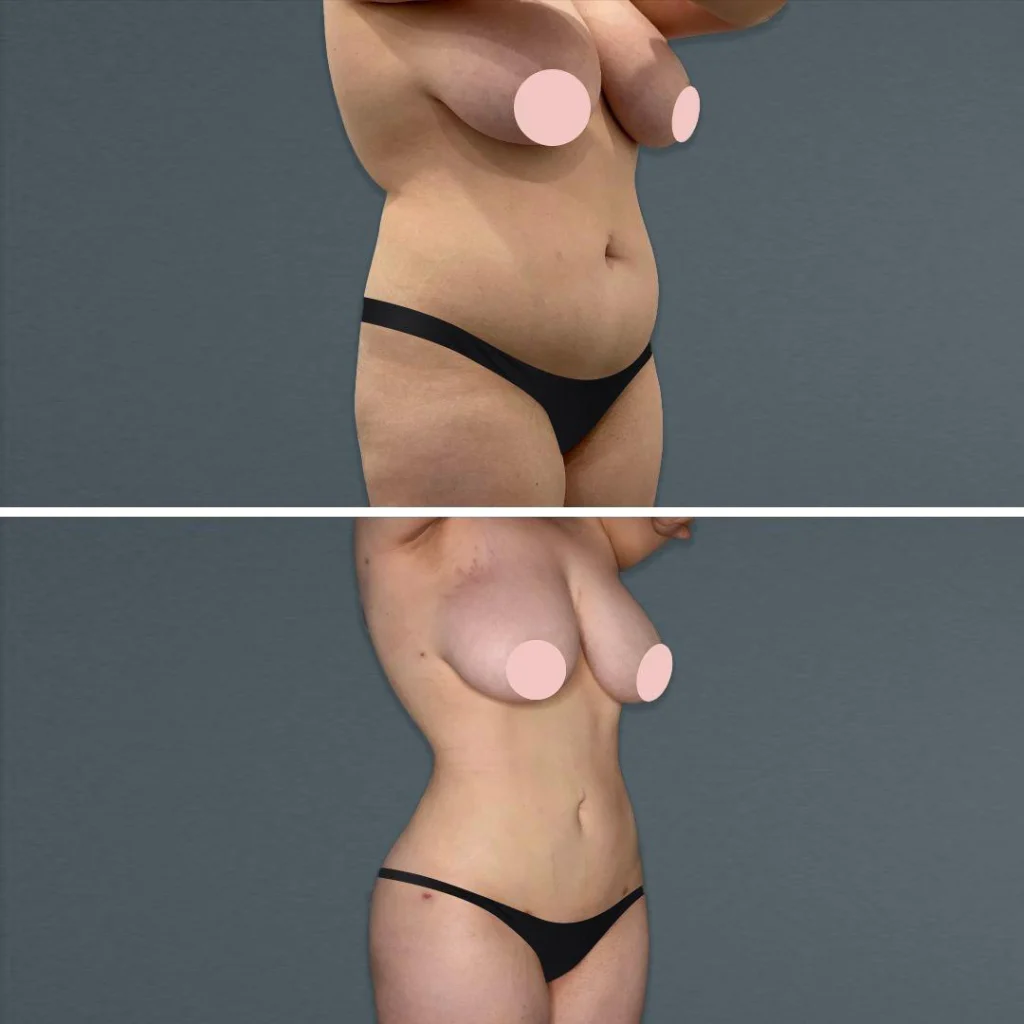 goldcoast megaliposuction stomach female 2022 left 70 before and after before and after