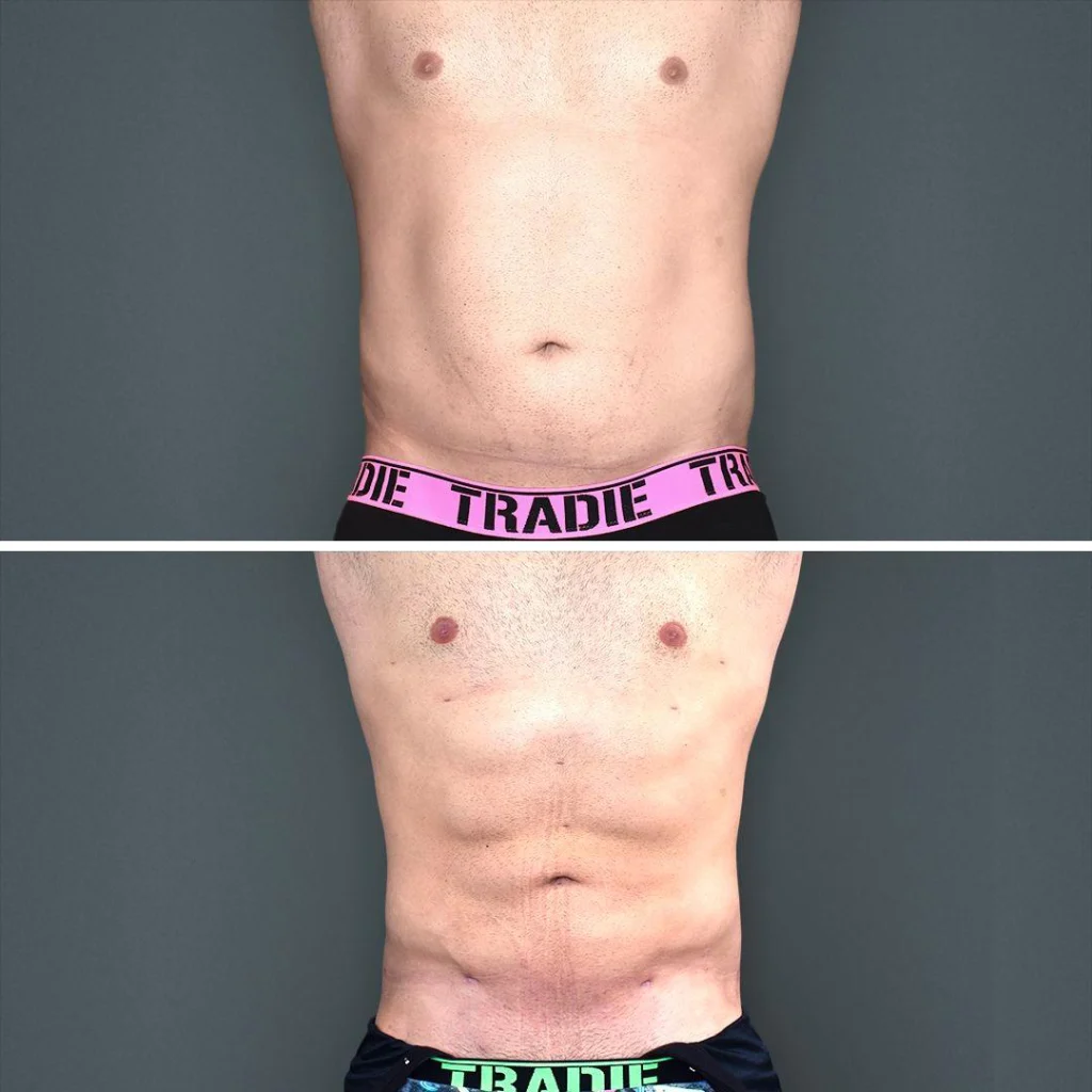 goldcoast vaserliposuction stomach male 2023 front 120 before and after before and after