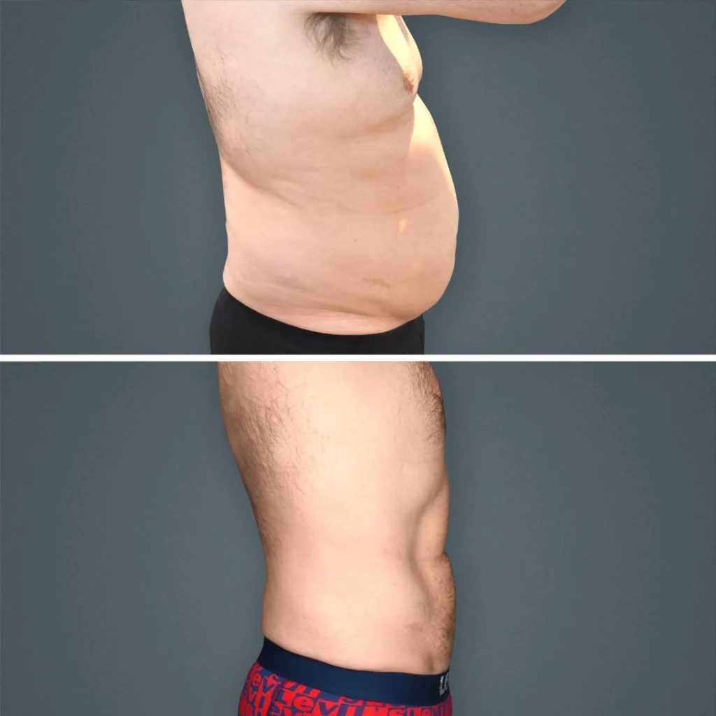 goldcoast vaserliposuction stomach male 2023 left 195 before and after before and after