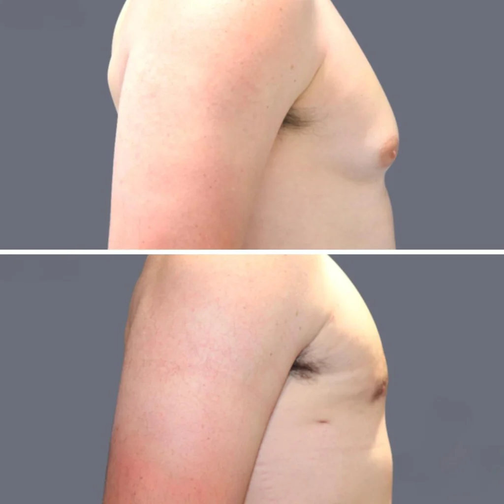 gynecomastia pre2024 002 before and after before and after
