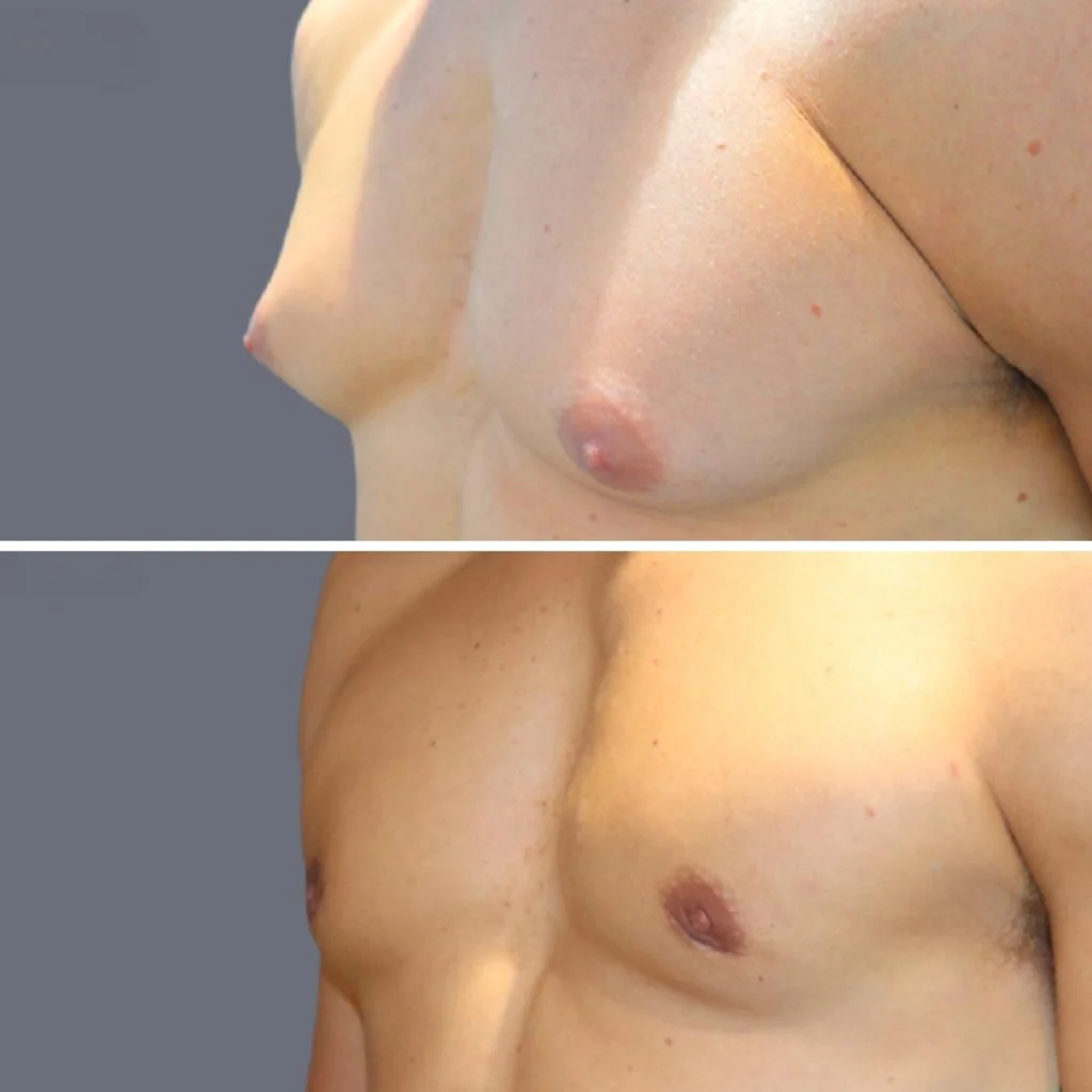 gynecomastia pre2024 003 before and after before and after