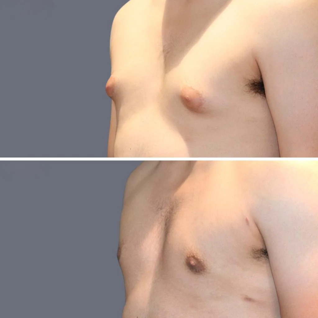 gynecomastia pre2024 004 before and after before and after