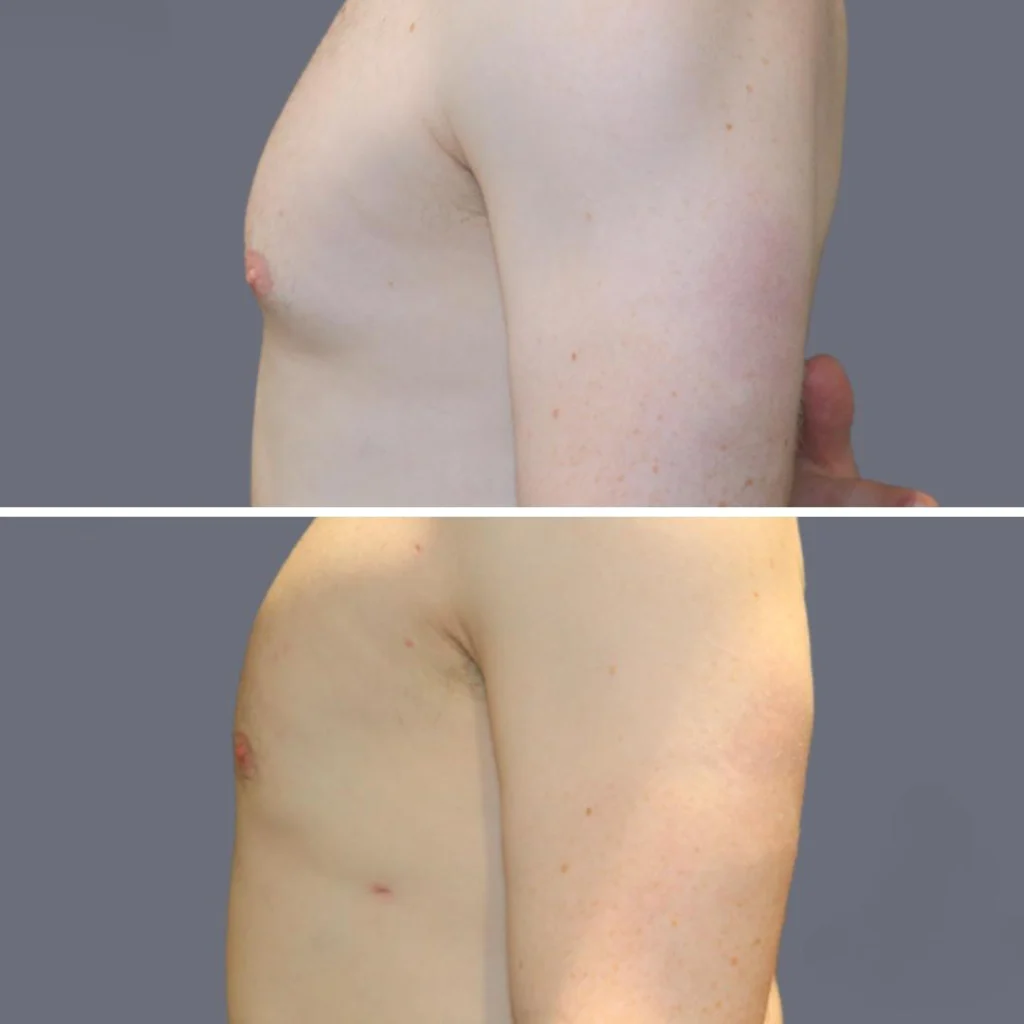 gynecomastia pre2024 005 before and after before and after