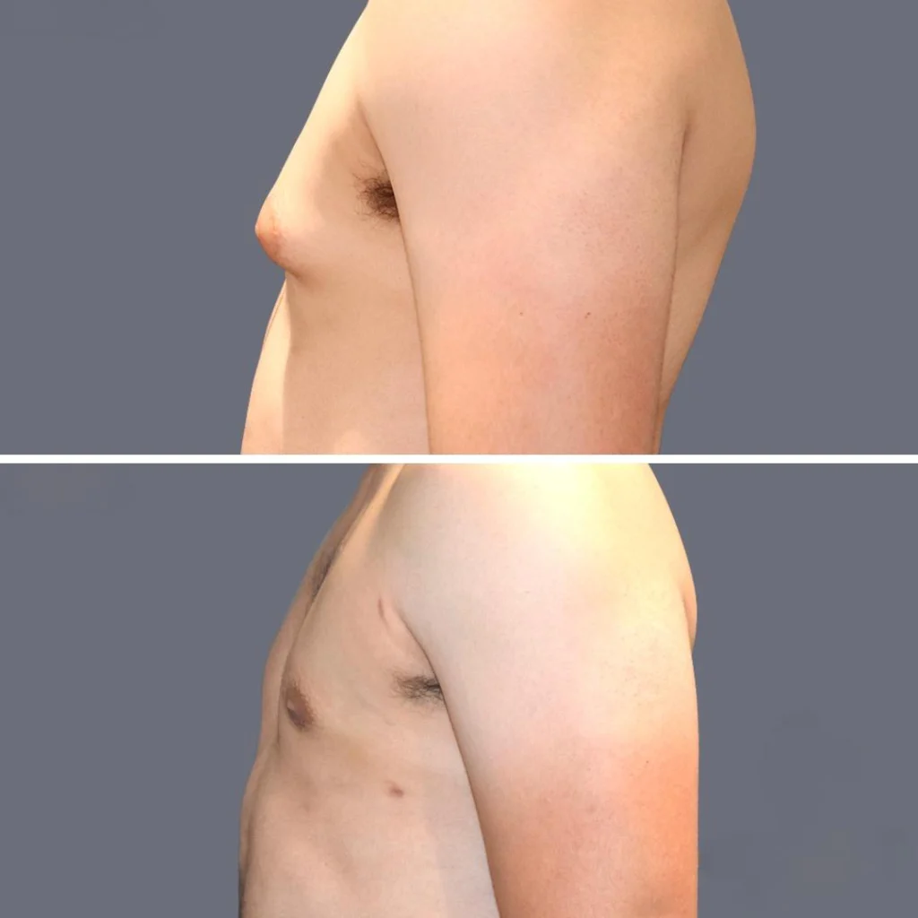 gynecomastia pre2024 008 before and after before and after