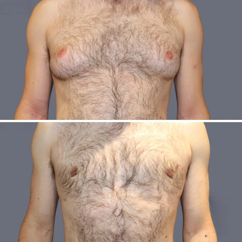 gynecomastia pre2024 009 before and after before and after