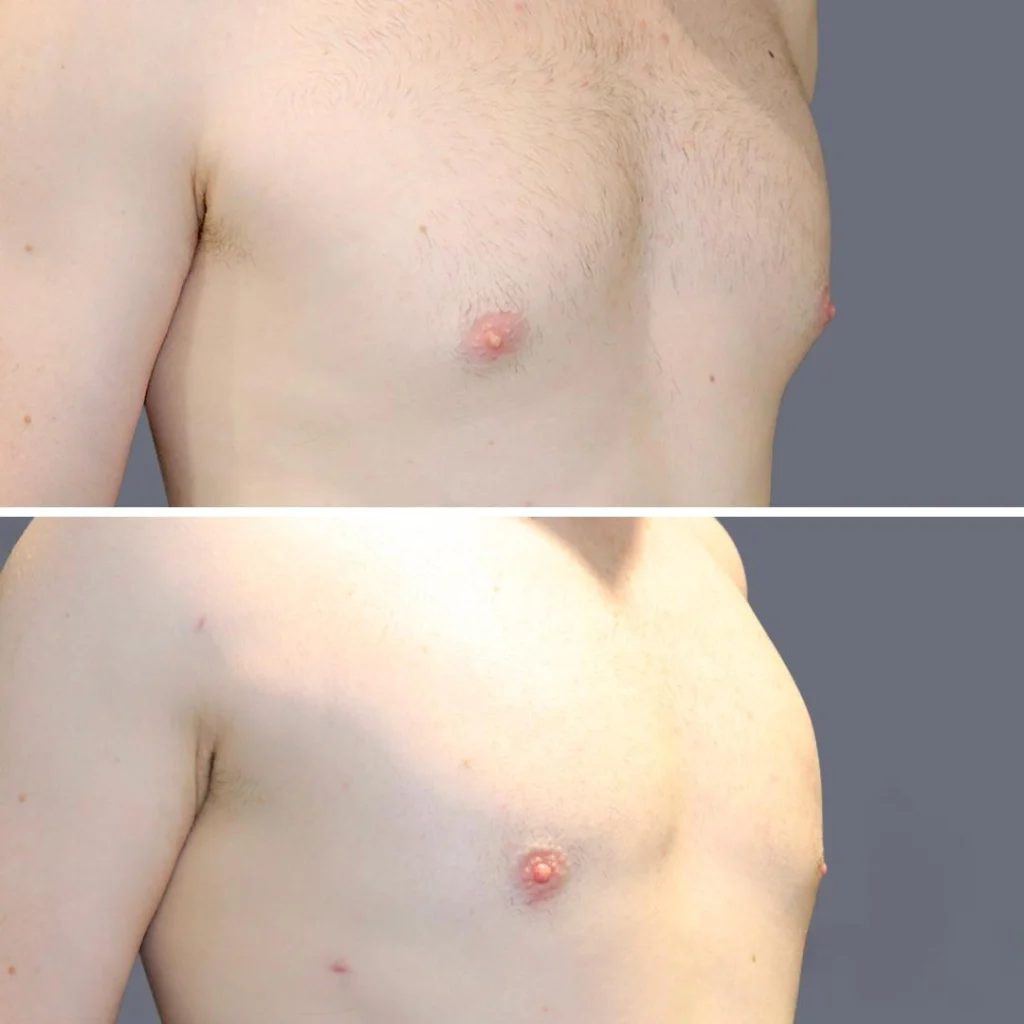 gynecomastia pre2024 010 before and after before and after