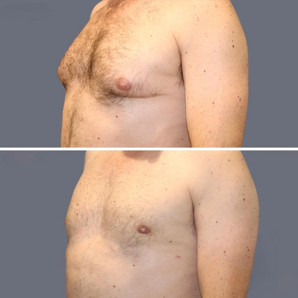 gynecomastia pre2024 011 before and after before and after