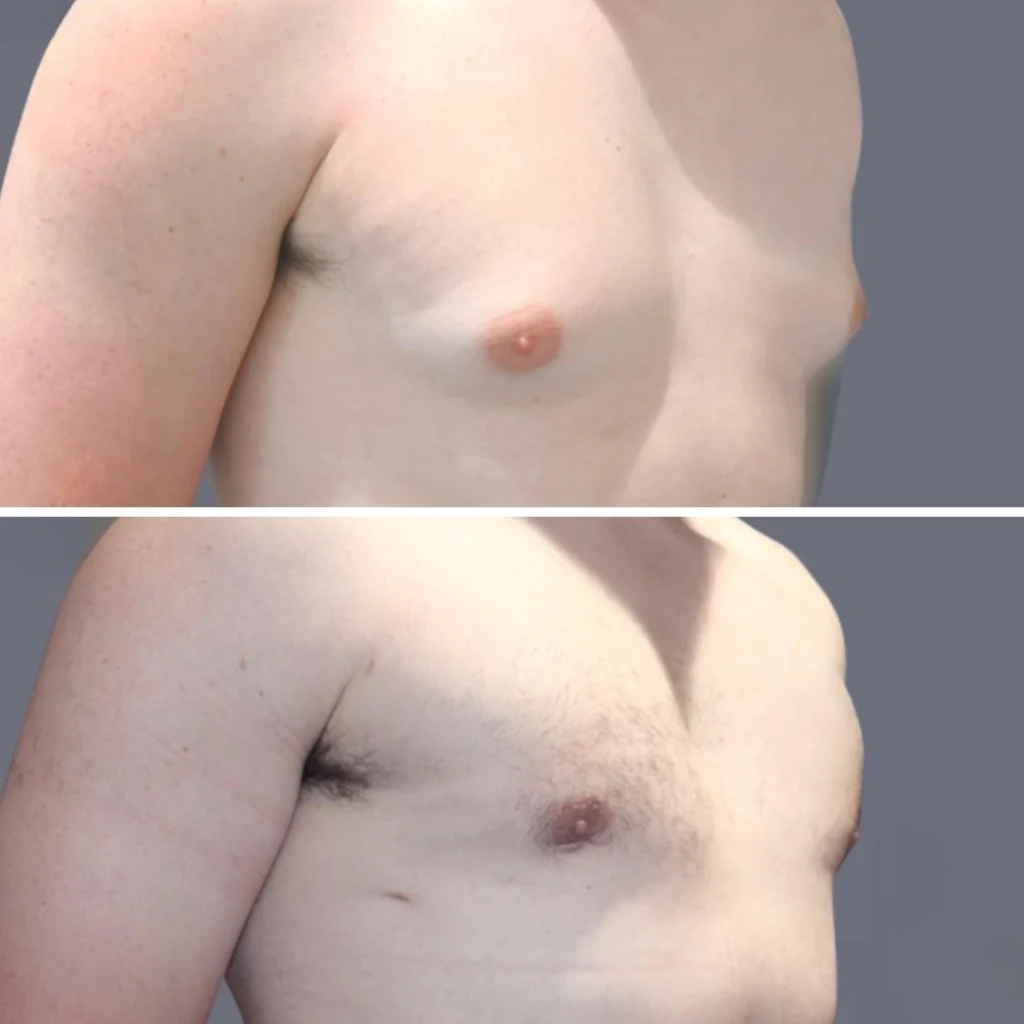 gynecomastia pre2024 012 before and after before and after