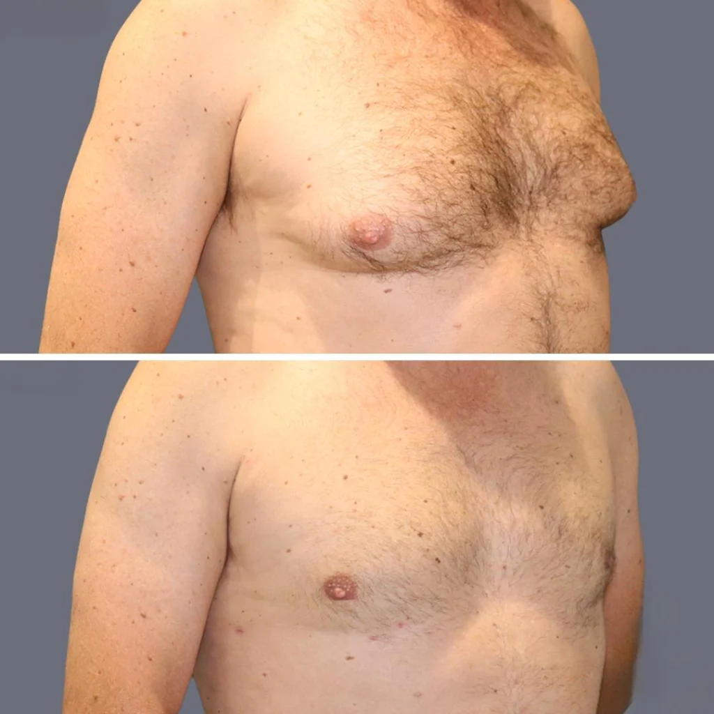gynecomastia pre2024 013 before and after before and after