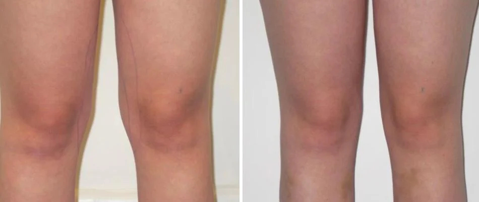 knee liposuction female pre2024 015 before and after before and after