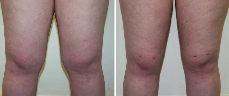 knee liposuction female pre2024 017 before and after before and after