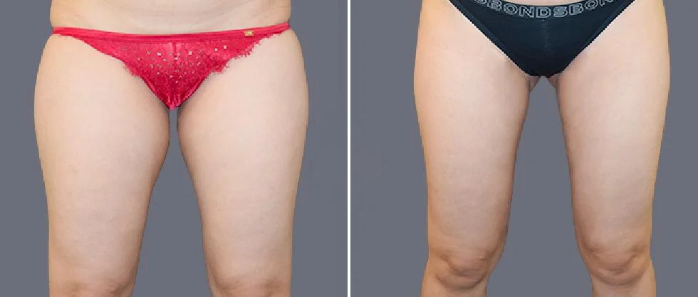 leg vaser pre2024 001 before and after before and after