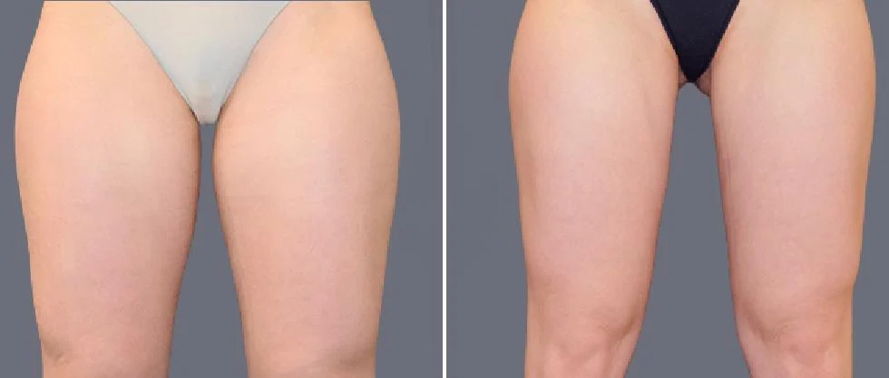 leg vaser pre2024 002 before and after before and after