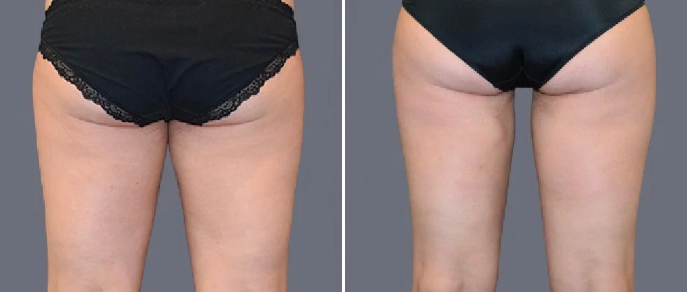 leg vaser pre2024 003 before and after before and after