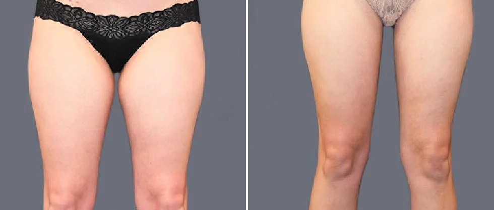 leg vaser pre2024 004 before and after before and after