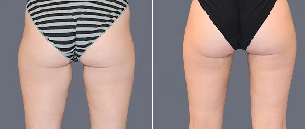 leg vaser pre2024 005 before and after before and after
