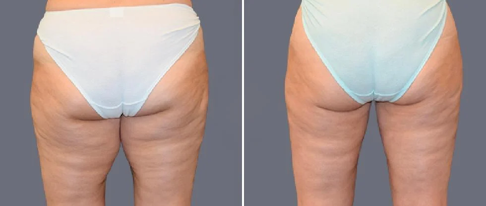 leg vaser pre2024 007 before and after before and after