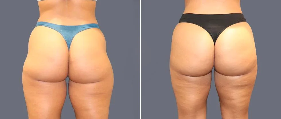 Before and after liposuction of the legs.