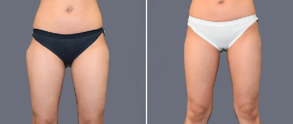 leg vaser pre2024 009 before and after before and after