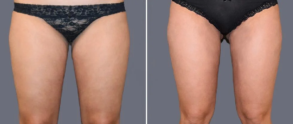 leg vaser pre2024 011 before and after before and after