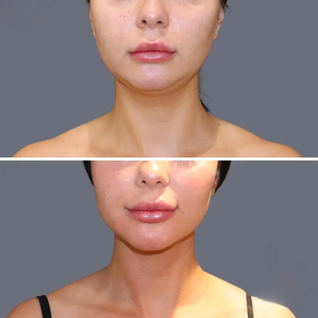 lowerface vaserliposuction female pre2024 001 before and after before and after