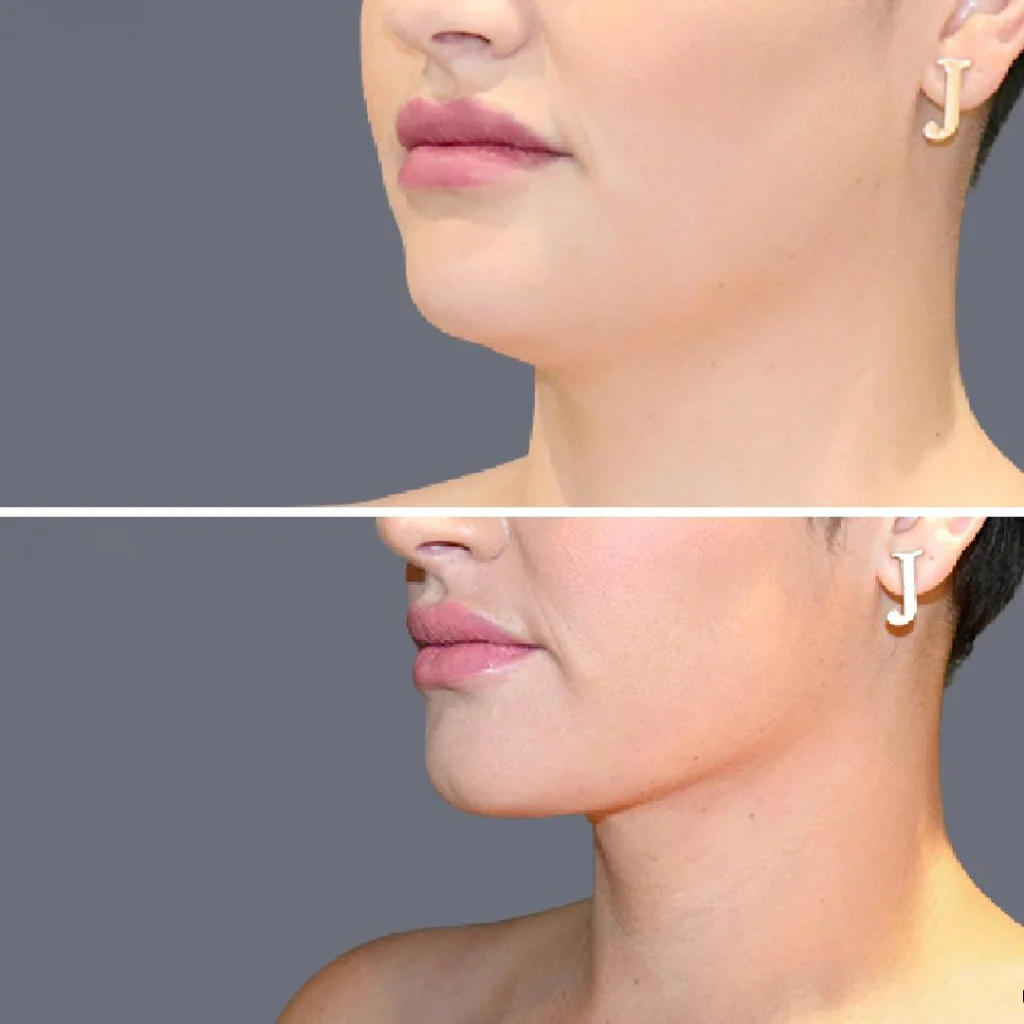 lowerface vaserliposuction female pre2024 002 before and after before and after