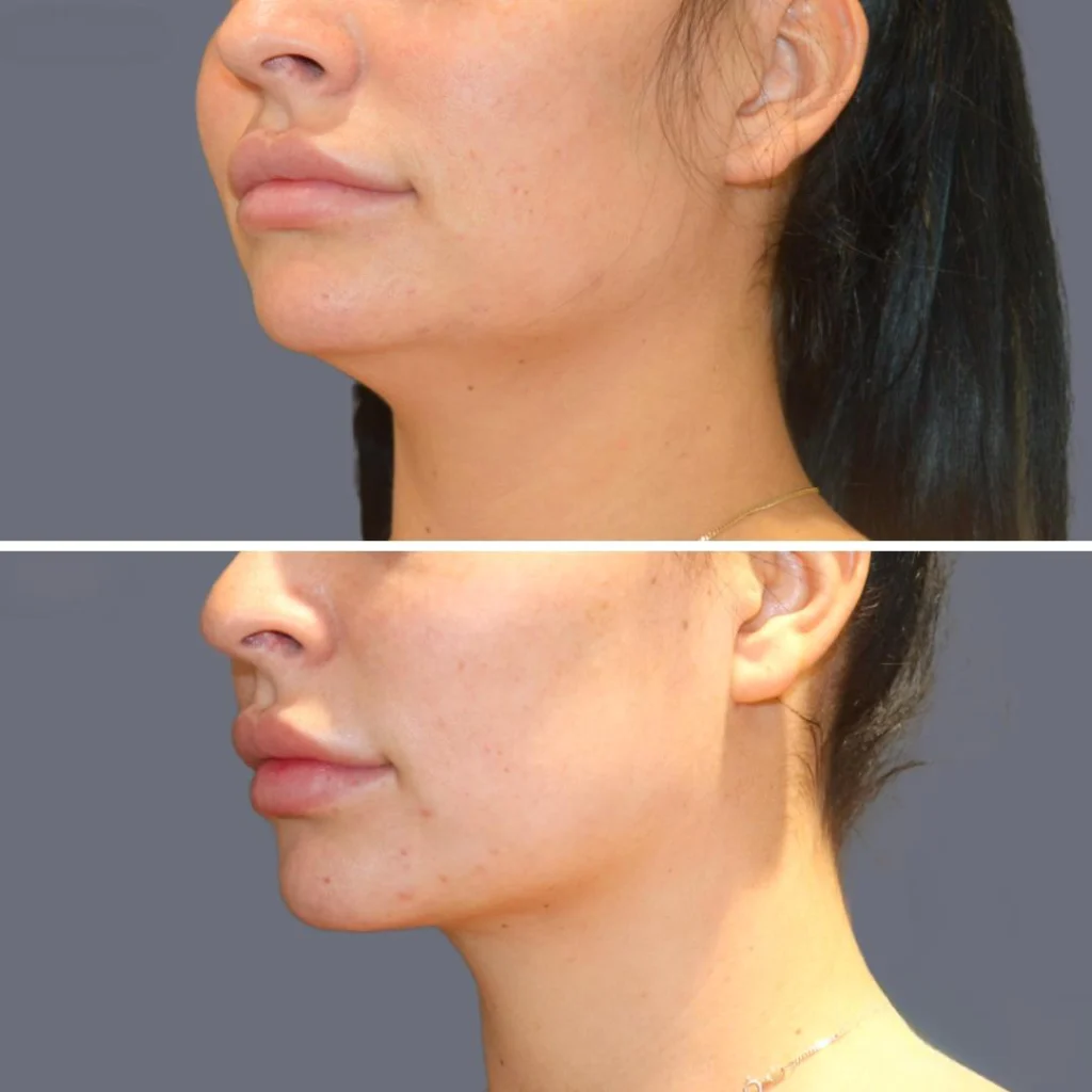 lowerface vaserliposuction female pre2024 003 before and after before and after