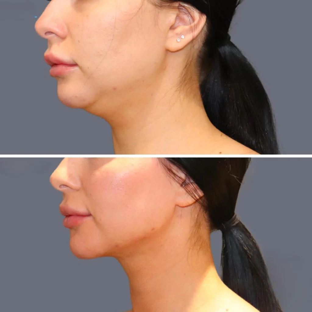 lowerface vaserliposuction female pre2024 004 before and after before and after