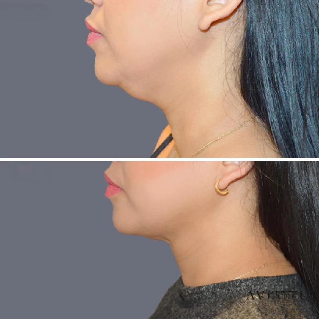 lowerface vaserliposuction female pre2024 005 before and after before and after