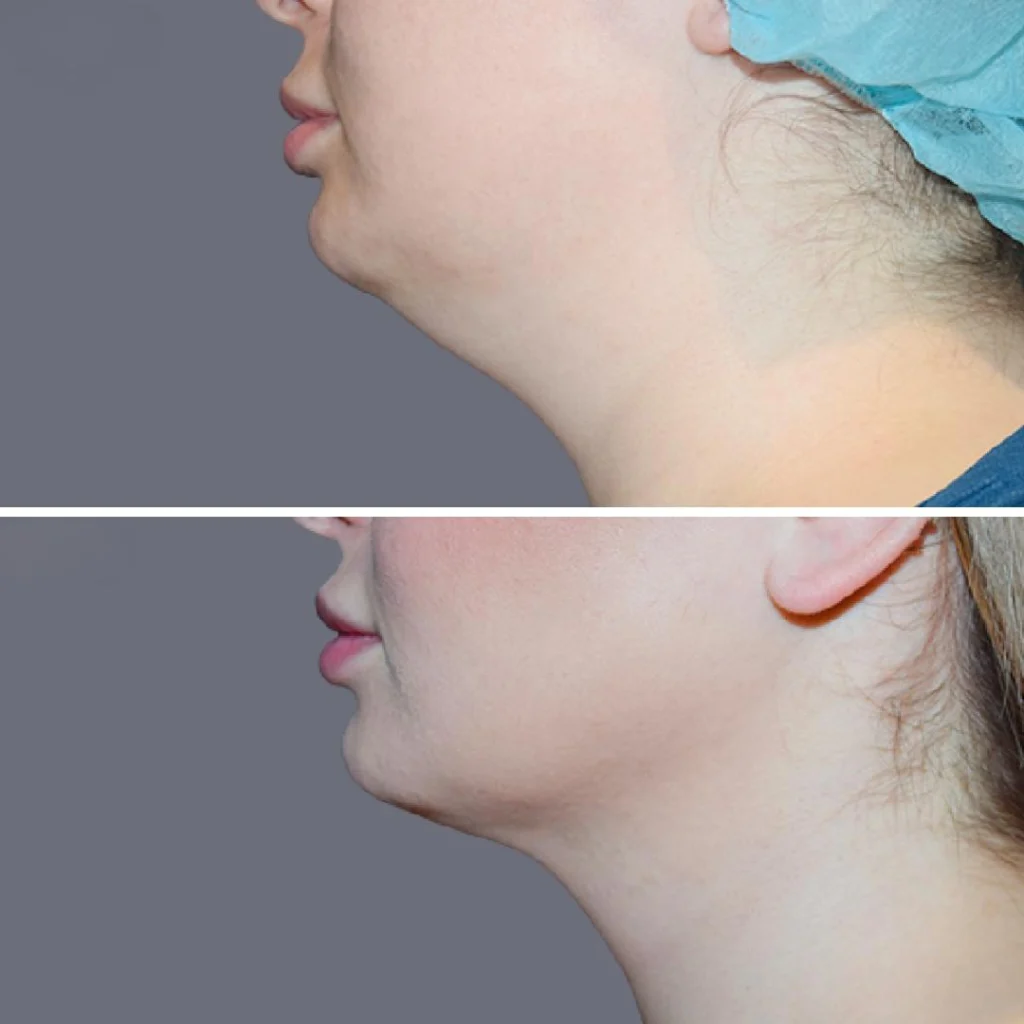 lowerface vaserliposuction female pre2024 007 before and after before and after