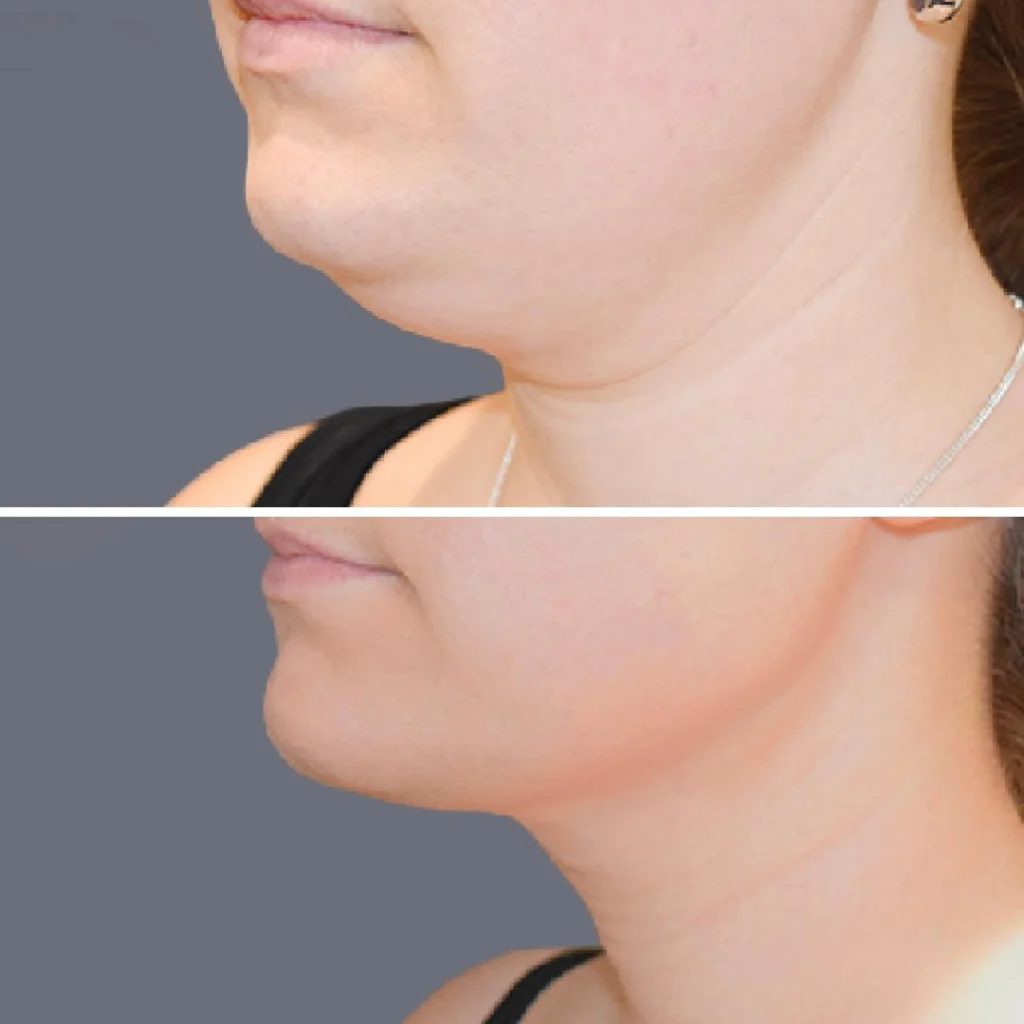 lowerface vaserliposuction female pre2024 008 before and after before and after