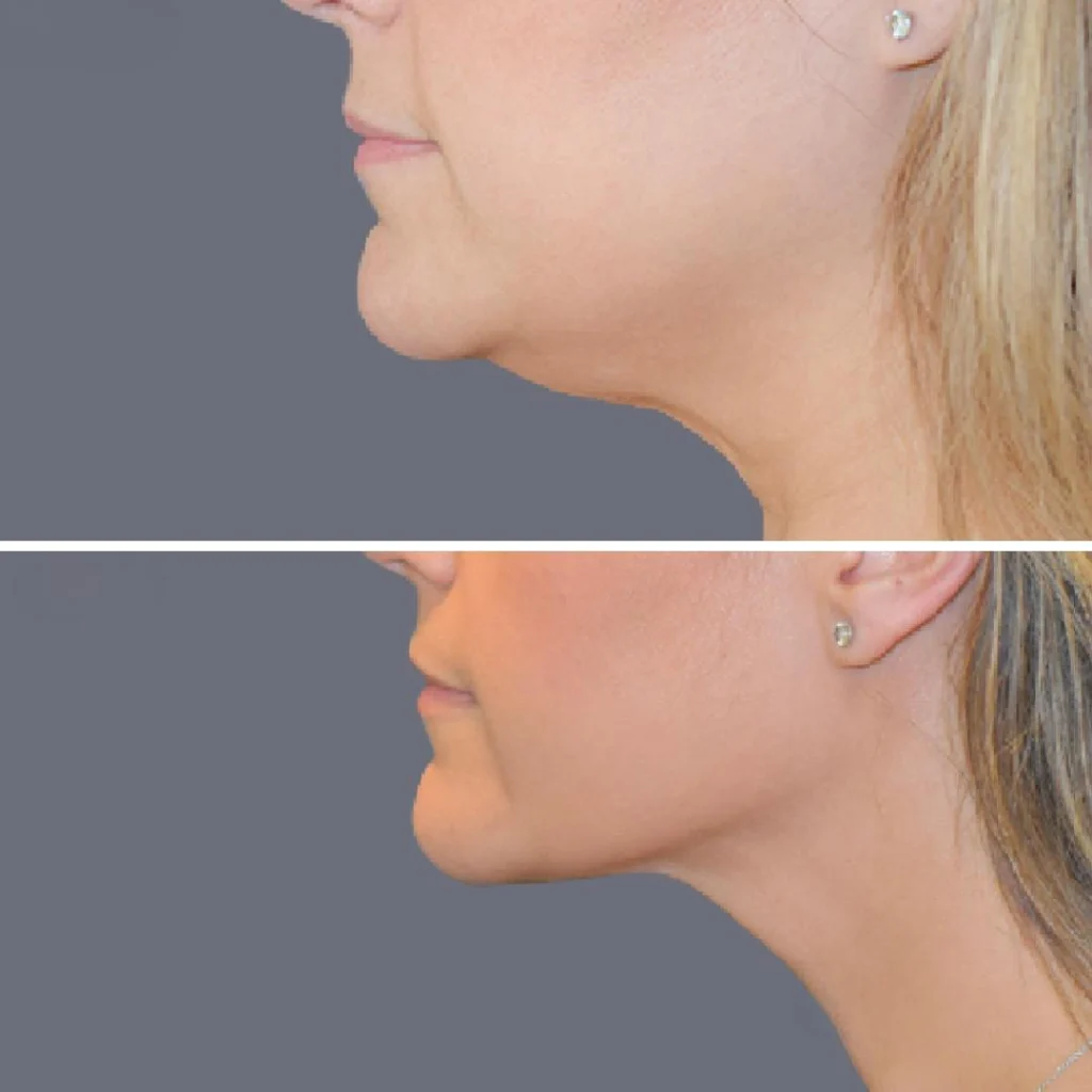 lowerface vaserliposuction female pre2024 009 before and after before and after