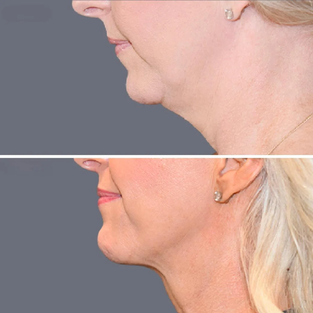 lowerface vaserliposuction female pre2024 011 before and after before and after