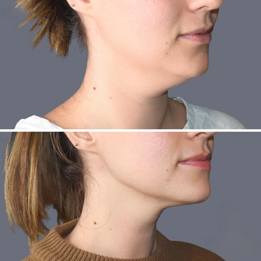 lowerface vaserliposuction female pre2024 012 before and after before and after