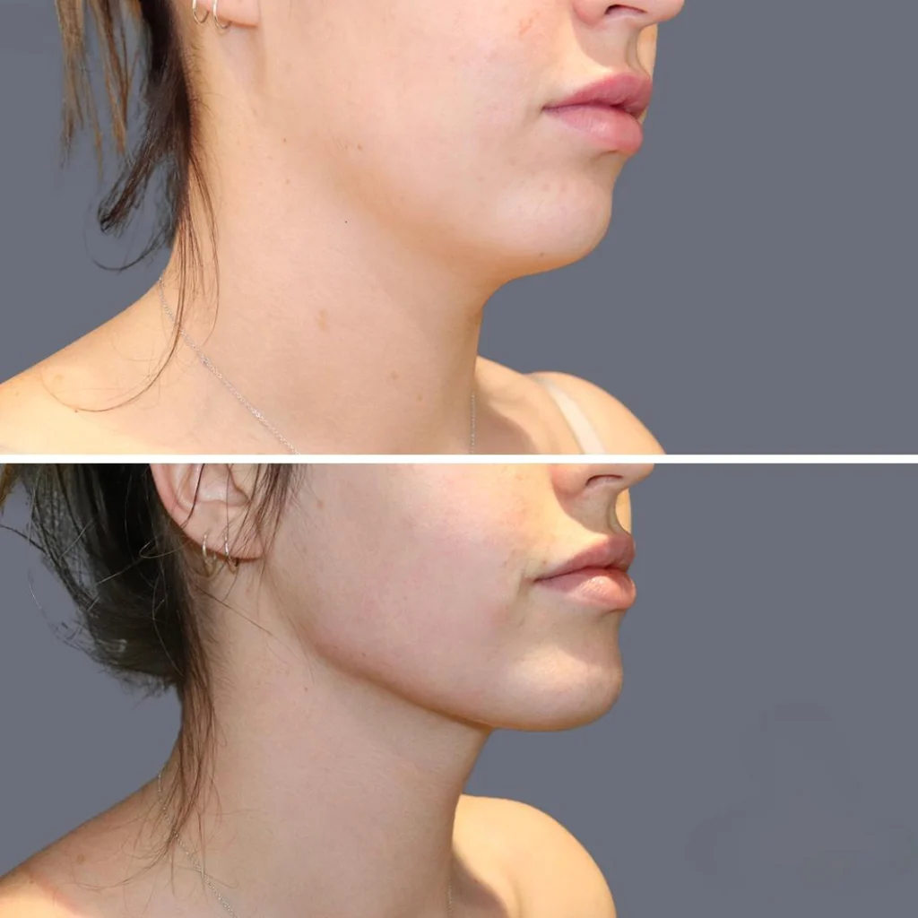 lowerface vaserliposuction female pre2024 017 before and after before and after