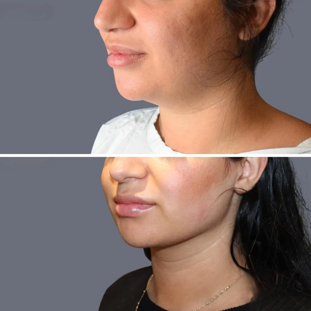lowerface vaserliposuction female pre2024 018 before and after before and after