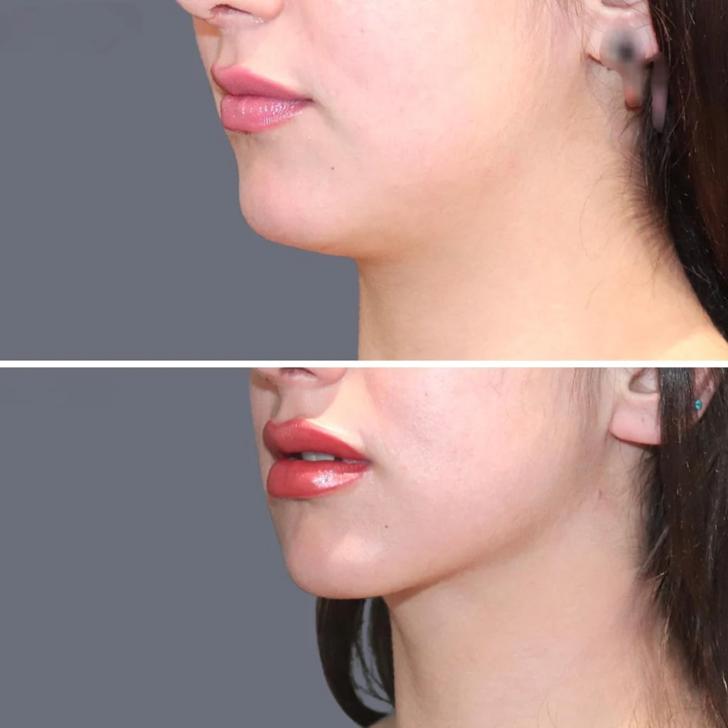 lowerface vaserliposuction female pre2024 019 before and after before and after