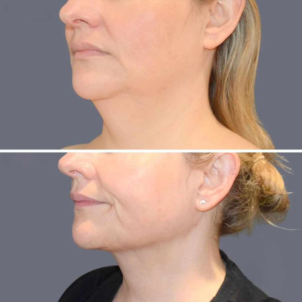 Before and after liposuction of the face.