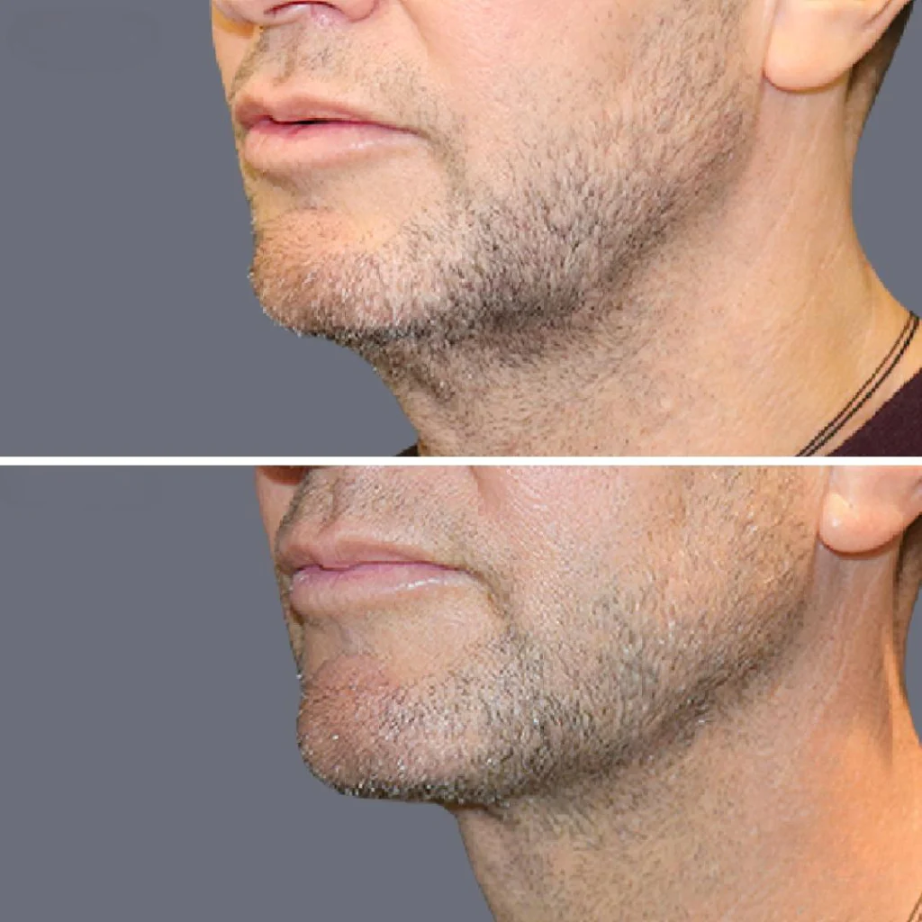 lowerface vaserliposuction male pre2024 006 before and after before and after