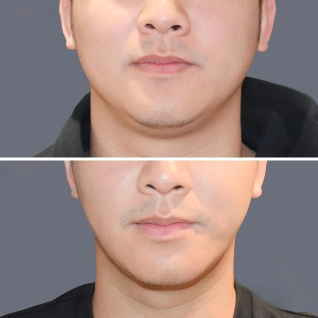 lowerface vaserliposuction male pre2024 013 before and after before and after